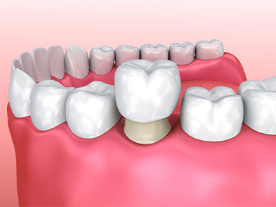 Crown Dental Group | Carrilas, All-on-4 reg  and CBCT