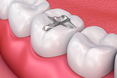 Crown Dental Group | Tratamiento periodontal, Puentes and Invisalign reg 