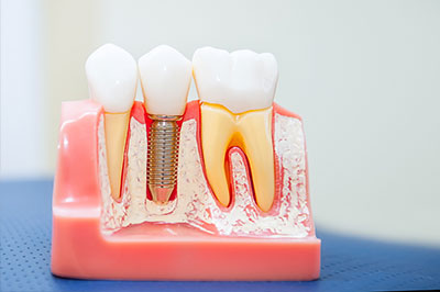 Crown Dental Group | Implantes del mismo dia, Ortodoncia and Reparaciones el mismo d  a