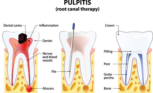 Crown Dental Group | Conducto Radicular, Tratamiento de emergencia and Odontolog  a de Implantes