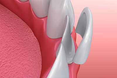 Crown Dental Group | Dentaduras en el mismo dia, Tratamiento de emergencia and Dispositivos para el ronquido