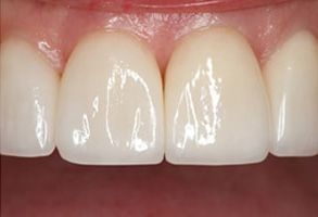 Crown Dental Group | Dentaduras en el mismo dia, Extracciones and Carrilas