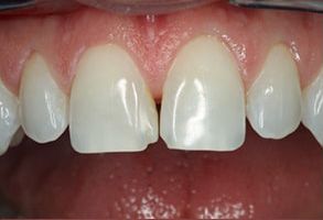 Crown Dental Group | Empastes Dentales, Protectores bucales deportivos and All-on-4 reg 